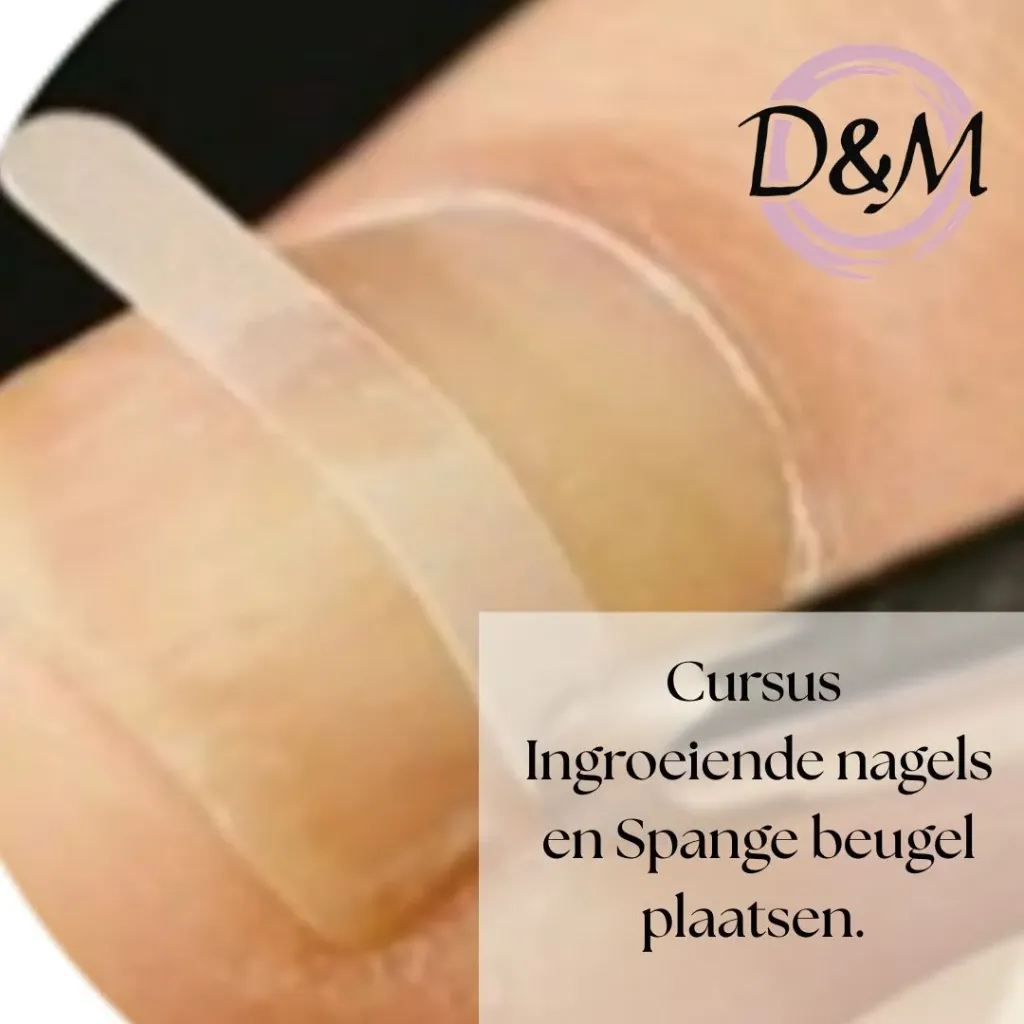 Ingroeiende nagels en spange beugel plaatsen